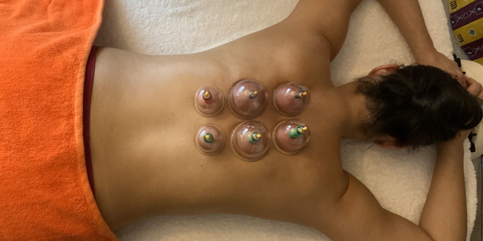 Cupping (ventouses)